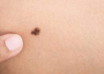 Πρόγραμμα πρόληψης μελανώματος